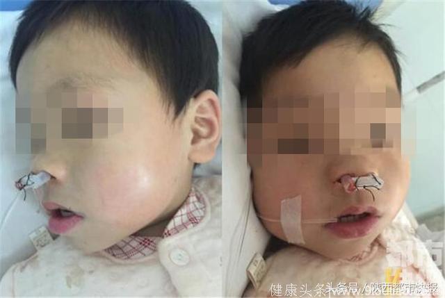 新生男婴患罕见疾病 无法用鼻呼吸