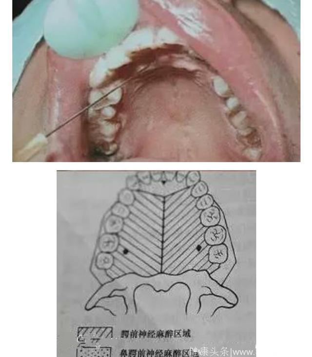 「学习」规范化操作之口腔常用几种麻醉图