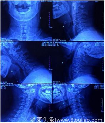 病例：颈椎病造成的神经压迫怎么办？