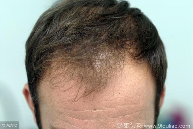 男性脱发并非无药可治，坚持敲头部、点穴位可缓解症状！