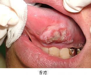 除了舌癌，舌头疼痛还有可能是哪些疾病？