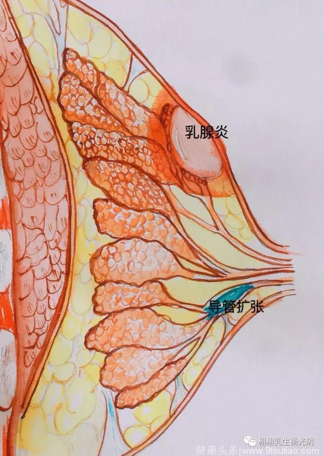 「转发」「精品」带你走进乳房：手绘水彩 图解乳房良性疾病