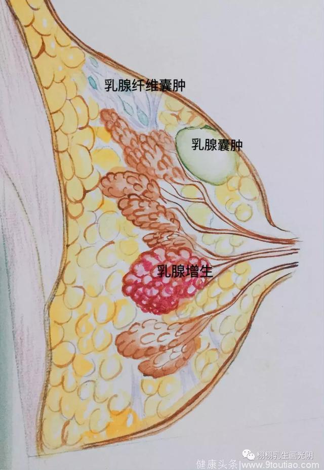 「转发」「精品」带你走进乳房：手绘水彩 图解乳房良性疾病