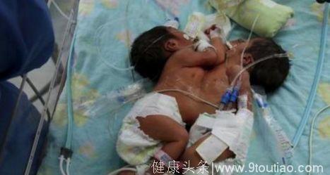 孕妇剖腹双胞胎，医生剖开肚子被孩子吓到了！