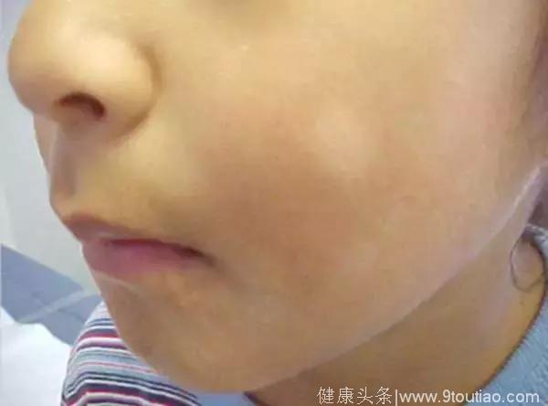 孩子脸上有白斑，要吃打虫药吗？