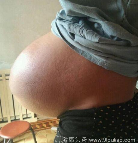 21岁孕妇肚大如藏“球”，医生检查完家属崩溃大哭！
