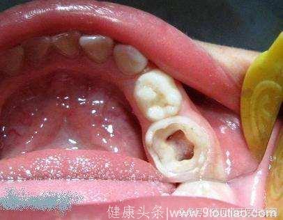 乳牙牙髓炎会不会影响恒牙