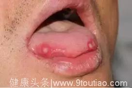 口腔溃疡不是缺维生素那么简单！