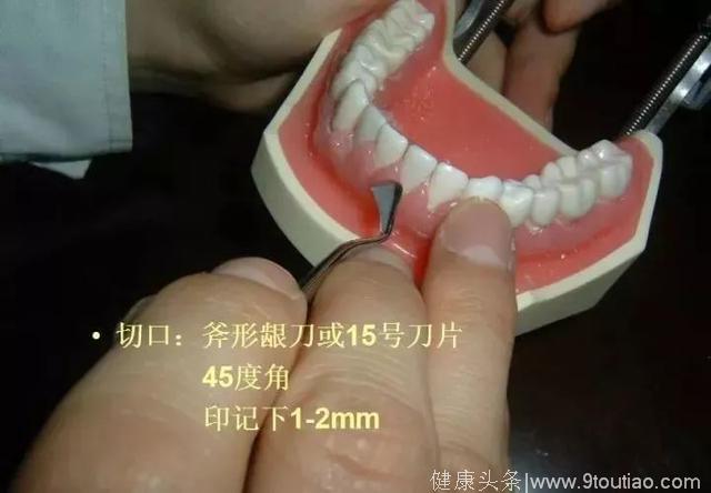 口腔医师临床技能—松牙固定术