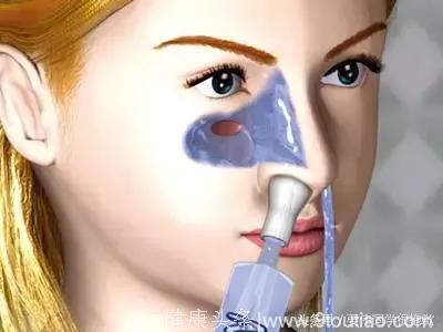 最为常见的五大鼻炎不典型症状及应对方法