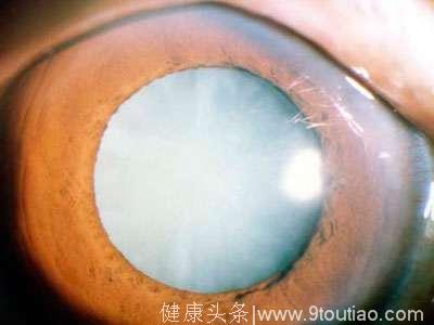 眼科专家呼吁：重视新生儿眼病筛查
