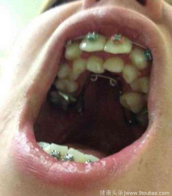 8岁小孩长出畸形双排牙，牙医检查完，父母全懵了