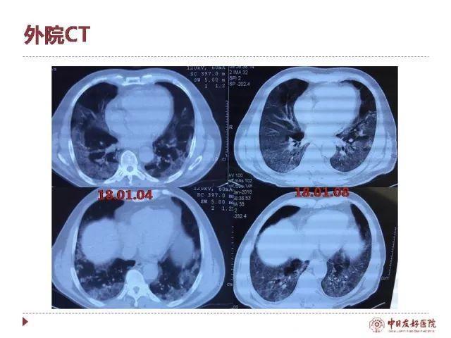 “岳父”经治专家详解《流感下的北京中年》救治过程，人工肺到底能否救命？