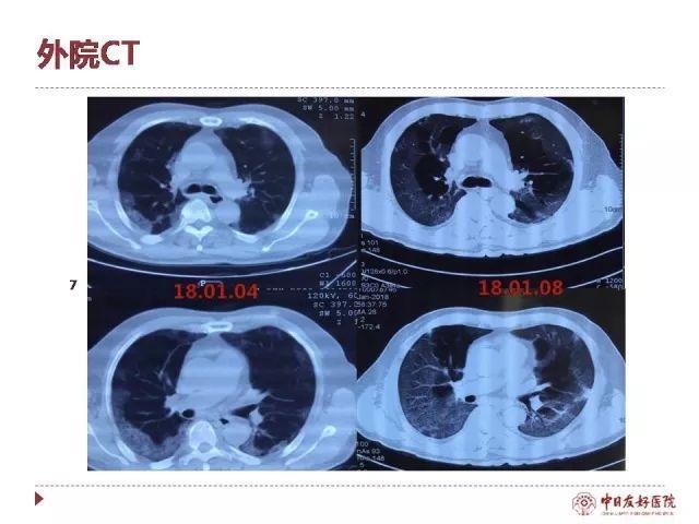 “岳父”经治专家详解《流感下的北京中年》救治过程，人工肺到底能否救命？