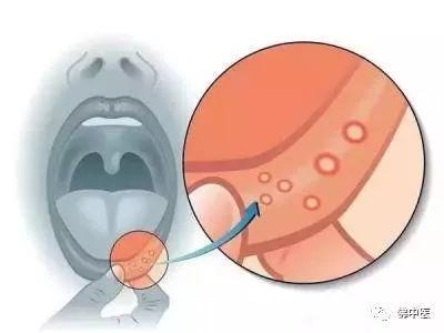 「专业」口腔生疮致吞咽困难，佛中医口腔黏膜病专科“有两把刷子”
