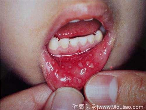 儿童口腔溃疡怎么办。事前预防好过事后治疗。