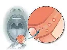 新年把西瓜霜涂在口腔溃疡上，疼痛消失！口疮长在哪，疾病就在哪