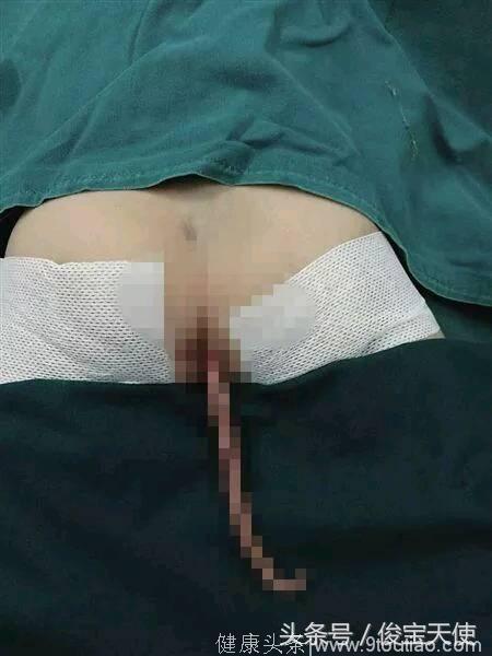 45岁产妇被婆婆逼着生二胎，结果孩子生下却长着尾巴，吓坏婆婆