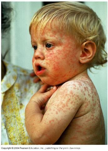 我看过最好的小儿感染性出疹性疾病皮疹图库！