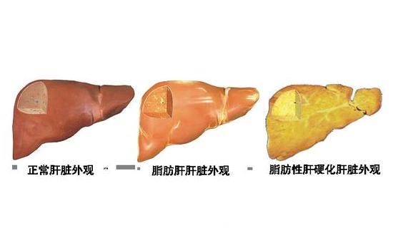 1件事会让肝脏在一夜之间变成黄色，3件事会让肝病变成肝癌