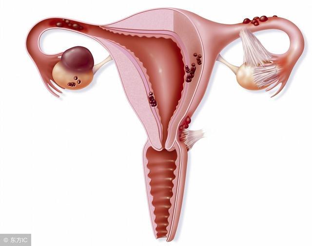5个因素引起子宫肌瘤