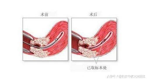 子宫出血是咋回事？