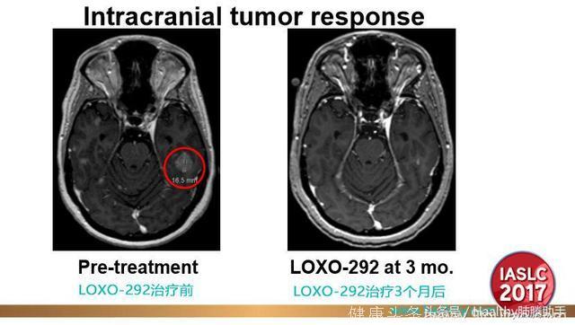 肿瘤居然缩小89%！新药LOXO-292难道是肺癌患者的新希望吗？