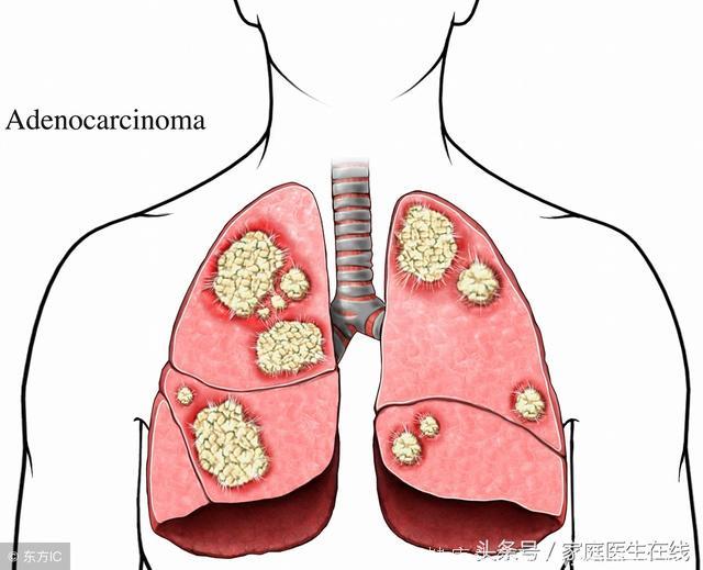 4种检查能提前“看穿”肺腺癌！只是很少人能全部做对