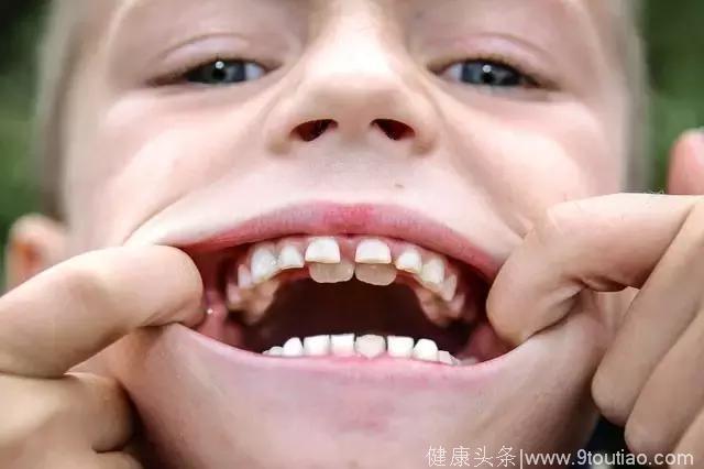 乳牙不重要，反正有恒牙？大错特错丨八大儿童口腔误区第二弹