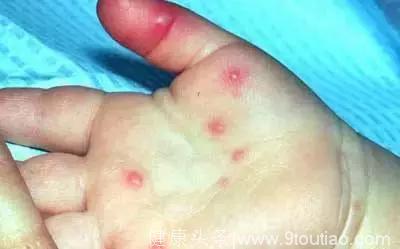 疱疹性咽峡炎和手足口是一回事儿吗？