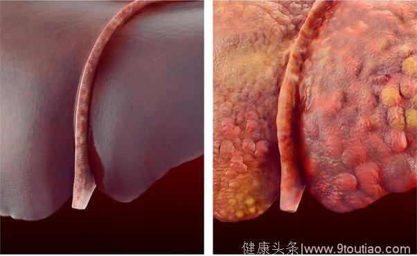 肝脏长时间被脂肪包围很危险，快吃点它给肝脏刮油排毒