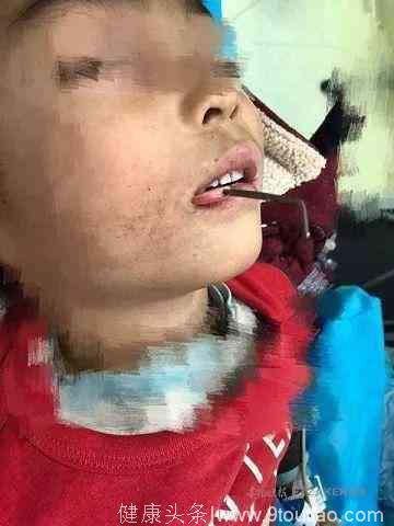 五岁男童被毛衣针刺穿口腔 医生巧用这个器械将其拔出