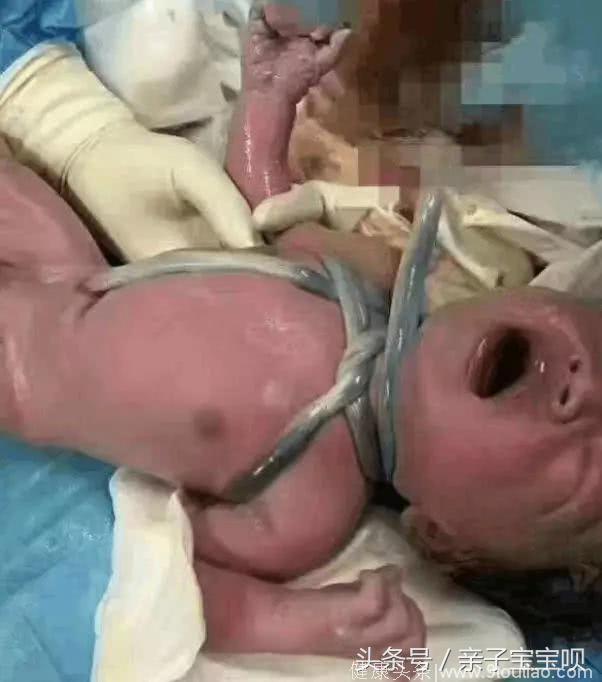 怀孕九个月产检，却被三轮车撞早产，紧急手术后，医生大呼撞的好