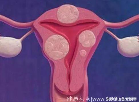 “子宫上，长了瘤子”！有这3种情况的女人千万要留心……