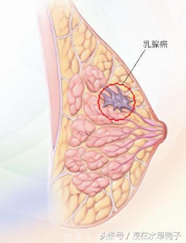 女性的高发癌症之一，乳腺癌的早期预防