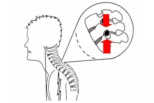 常常后仰头部，对颈椎“曲度变直”真的有用吗？