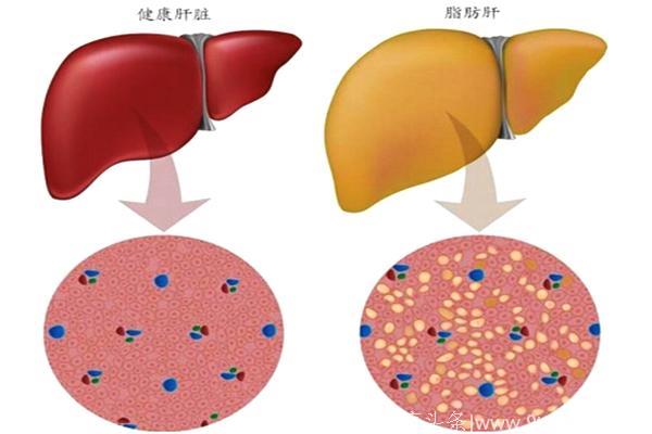 这三点才是脂肪肝的元凶，老中医：一物泡水喝可防脂肪肝