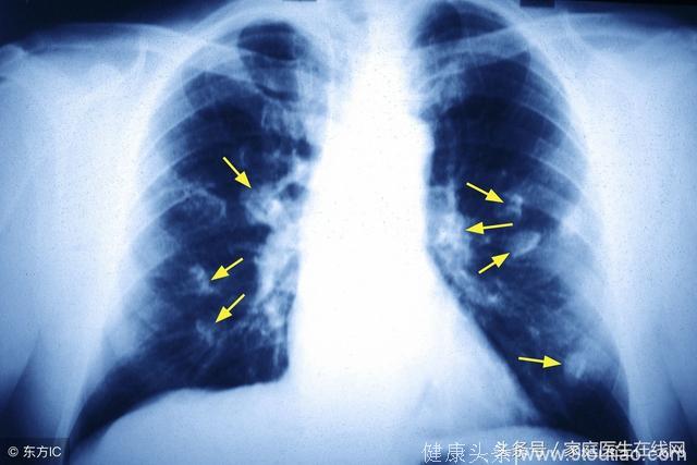 为什么越来越多人得肺癌？医生总结出了这4个因素！