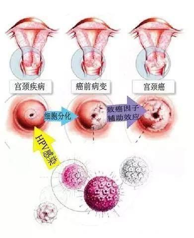 女人如果出现了这5种症状，小心是早期宫颈癌，子宫才是女人资本