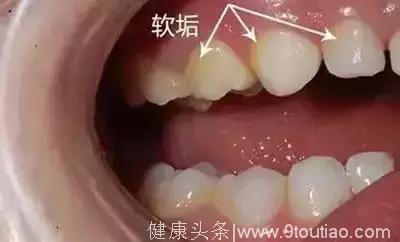 小朋友牙齿上的黑色斑点是什么？