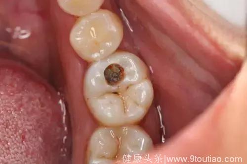 小朋友牙齿上的黑色斑点是什么？