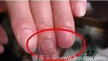 「指甲有黑线，肝脏在病变」快看看你的指甲，别到乙肝晚期才发现