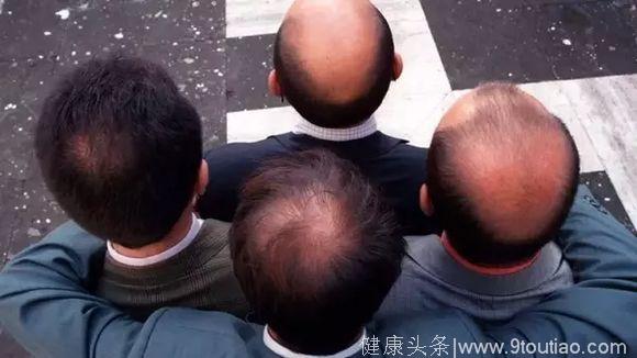 日本的秃顶率有多高？每4个人就有1个面临秃头造成的十万点伤害