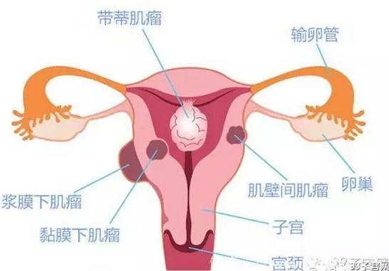女人的烦恼：子宫肌瘤