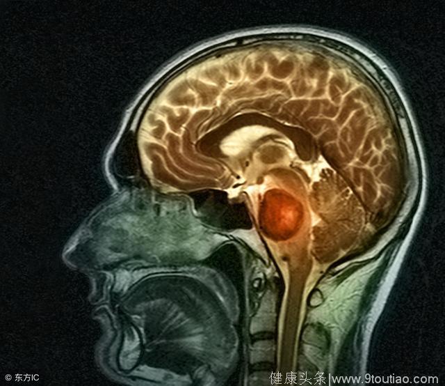 当癌症长在脑子里——你了解“脑癌”吗？