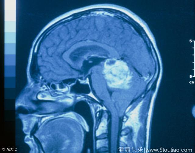 当癌症长在脑子里——你了解“脑癌”吗？