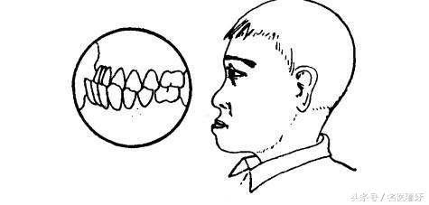 北大口腔博士科普：孩子“地包天”该如何治疗？