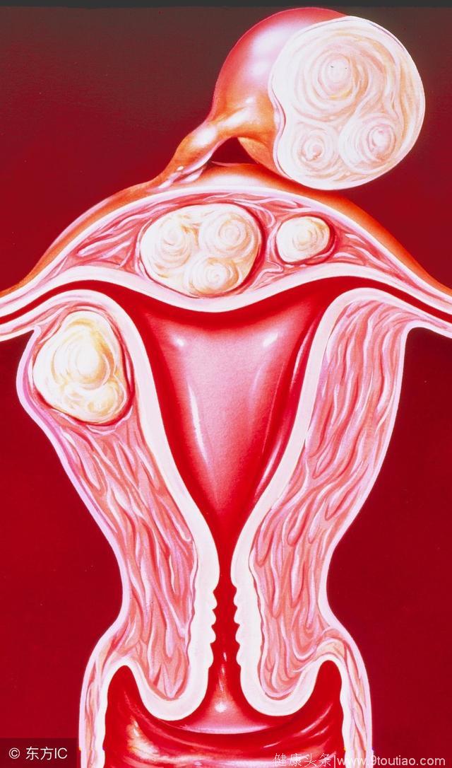 子宫肌瘤早期的信号“月经改变”