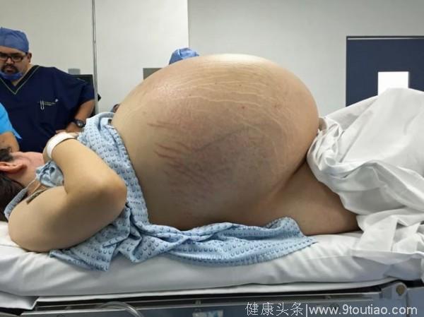 女孩“怀孕”1年不见生，医院从肚子里取出这东西，重达60斤！