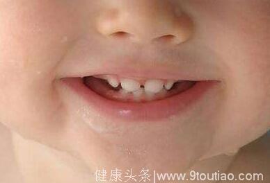 儿童为什么乳牙会早失